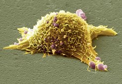 Entartete Pigmentzelle aus der Haut. Ein Immunsystem mit vielen HLA-Varianten kann Krebszellen wie diese leichter erkennen und bekämpfen. Entsprechend ist eine Immuntherapie bei Hautkrebspatienten mit hoher Variabilität dieser Gene effektiver, allerdings ruft die Behandlung bei solchen Patienten auch öfter Entzündungen hervor.